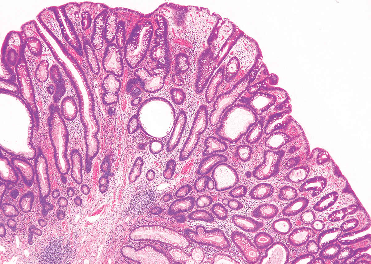 Tubuläres Adenokarzinom